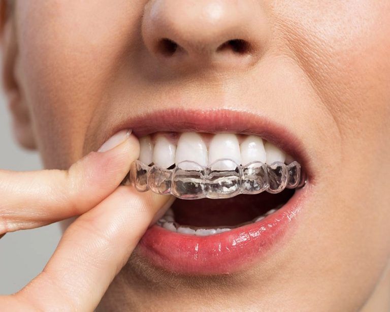 Brackets VS Invisalign® Clínica Dental Dra. Salmerón Dentista en Madrid